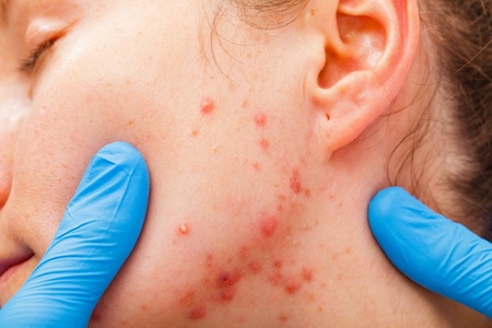 Traitement acné et cicatrices d'acné à Marseille | Médecine et ...