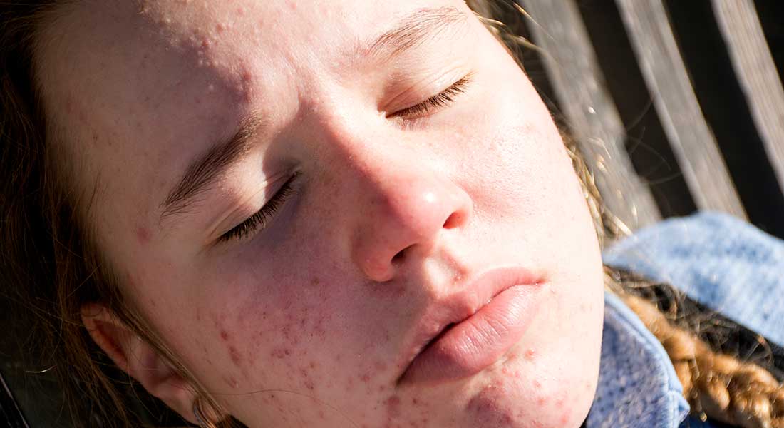 Soleil et acné : démêler le vrai du faux
