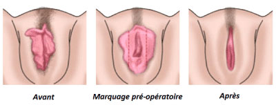 Avant / après labiaplastie médicale