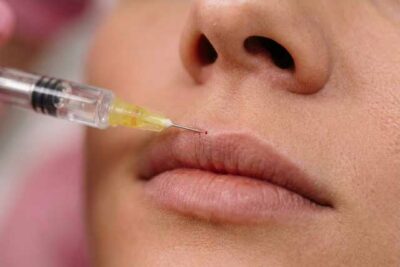 Injection des lèvres à Marseille